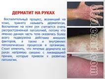 Шкірний дерматит - фото, лікування, важливе про захворювання шкірний