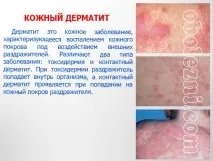 Шкірний дерматит - фото, лікування, важливе про захворювання лікування