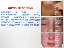 Шкірний дерматит - фото, лікування, важливе про захворювання фото