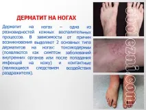 Шкірний дерматит - фото, лікування, важливе про захворювання дерматит