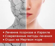 псоріазу
