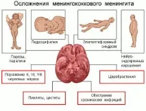 Менінгіт - причини, симптоми, діагностика, лікування, ускладнення симптоми