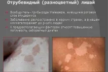 Висівкоподібний лишай (різнокольоровий, кольоровий) лікування та причини появи причини
