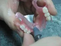Ремонт протезів з поліпропілену, NewDental поліпропілену