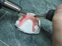 Ремонт протезів з поліпропілену, NewDental протезів