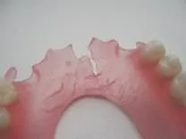 Ремонт протезів з поліпропілену, NewDental поліпропілену