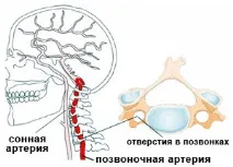 Синдром хребетної артерії (синдром Баре - Льєу, базилярна мігрень та ін.) симптоми та лікування артерії