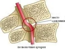 Синдром хребетної артерії (синдром Баре - Льєу, базилярна мігрень та ін.) симптоми та лікування синдром