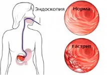 Нудота при гастриті може з’явитися і як позбутися нудота