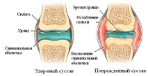 Тяжкість у ногах причини, симптоми, що робити і як лікувати ногах