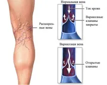 Тяжкість у ногах причини, симптоми, що робити і як лікувати ногах