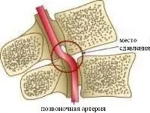 Артеріальна гіпертонія при шийному остеохондрозі причини, симптоми, лікування артеріальна