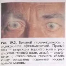 19.2. Ендокринна офтальмопатія залози