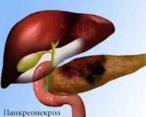 Що можна їсти при панкреонекрозі, після операції, фрукти їсти