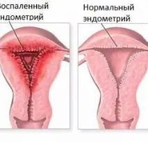 Ендометрит симптоми та лікування симптоми