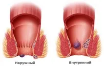 хемороиди