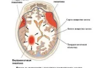 Гематома у новонародженого гематоми