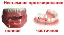 Які зубні протези краще ставити ставити