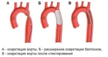 коарктация