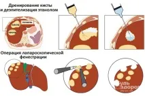 Кіста печінки - симптоми, лікування, видалення кіста