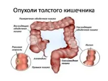 Кишкова непрохідність, лікування непрохідність
