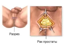 ЛРПЕ