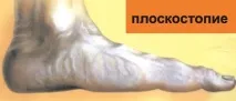 Ортопедичні вироби при шпорі п’яти. навантаження