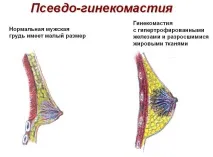 Підліткова гінекомастія у хлопчиків гінекомастія
