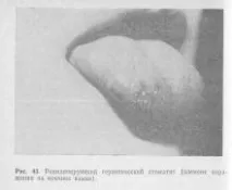 герпетичний