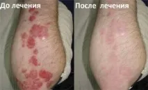 Саліцилова мазь при псоріазі мазь