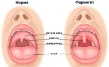 Сильний біль у горлі без температури – причини, лікування температури