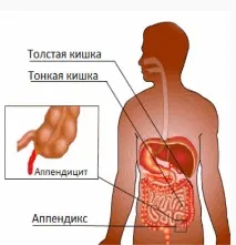 З якого боку з’являються болі при запаленні апендикса якого