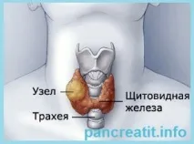 Тиреотоксикоз, гіпотиреоз щитовидної залози, вузли тиреотоксикоз