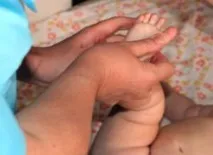 Вальгусна деформація стопи у дітей стопи