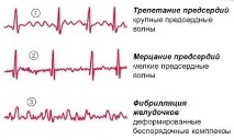 Види аритмії серця симтоматика та їх лікування серця