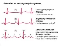 Види аритмії серця симтоматика та їх лікування серця