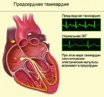 Види аритмії серця симтоматика та їх лікування види