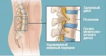 Хірург відмовив дядька від операції, порадивши робити ці вправи відмовив