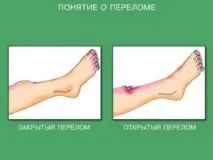 Надання першої допомоги за різних видів переломів першої