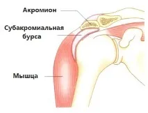 Бурсит плечового суглоба - симптоми та лікування плечового