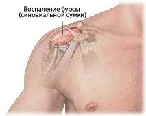 Бурсит плечового суглоба - симптоми та лікування бурсит