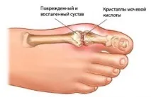 Що таке подагра і як з нею боротися. боротися