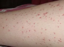 Глистні захворювання, з якими найчастіше стикаються люди захворювання