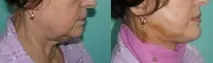 Як підтягнути підборіддя на 10 років Як прибрати друге підборіддя без операції Допоможе підтягнути