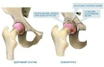 Коксартроз тазостегнового суглоба причини, ступеня та симптоми ступеня