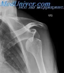 Коли з місця сходять кістки місця