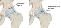 Коксартроз тазостегнового суглоба причини, ступеня та симптоми причини