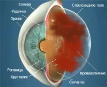 Крововиливи в склоподібне тіло склоподібне