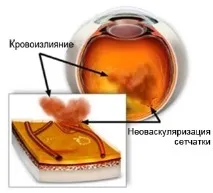 Крововиливи в склоподібне тіло склоподібне