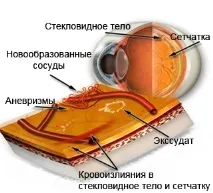 Крововиливи в склоподібне тіло крововиливи